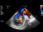 Echocardiography Ultrasound Machine | Cardiac Doppler Imaging System